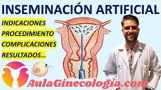 INSEMINACIÓN ARTIFICIAL INDICACIONES PROCEDIMIENTO RESULTADOS  Ginecología y Obstetricia [upl. by Sean]