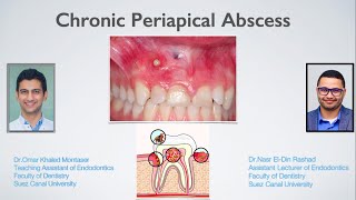 Management of Chronic Periapical Abscess Arabic [upl. by Silber801]