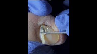 What I Learned from Removing 100 Ingrown Toenails Will Shock You [upl. by Roehm]