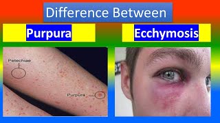 PURPURA Vs ECCHYMOSIS [upl. by Bulley]