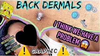 ALL YOU NEED TO KNOW “Graphic” BACK Dermal piercing video 💯🤯INFORMATIVE [upl. by Joris831]