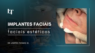 Implantes Faciais Estéticos [upl. by Dloreg]