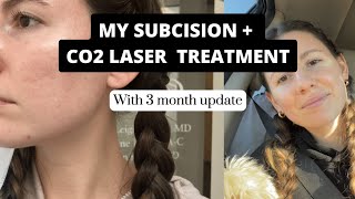 Getting a subcision  ablative CO2 Laser treatment  3 month update [upl. by Pacorro]