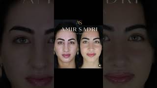 Rhinoplasty London  Dr Amir Sadri [upl. by Rufford]