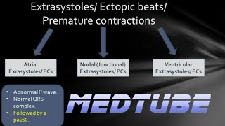 ECGs abnormal rhythms Extrasystoles [upl. by Godbeare9]