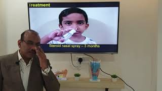 Otitis media with effusion Malayalam Patient teaching programme [upl. by Prager]