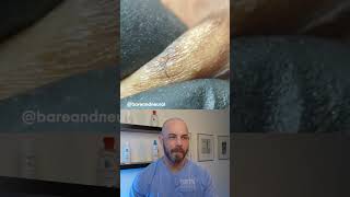 Ingrown hair frenzy ingrownhair dermreacts doctorreacts [upl. by Ecnerwaled]