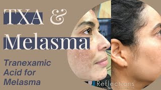 Tranexamic Acid for Melasma Skip Creams amp Pills  Try This Instead TranexamicAcidforMelasma [upl. by Eneri]