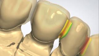 7 unit PFM with Metal Linguals Guide Planes Cingulum and Distal rest seat [upl. by Notlef107]