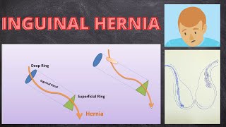 Inguinal Hernia  How to take History  How to Examine [upl. by Neelra]