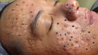 Big Cystic Acne Blackheads Extraction Blackheads amp Milia Whiteheads Removal Pimple Popping  8622 [upl. by Golter416]