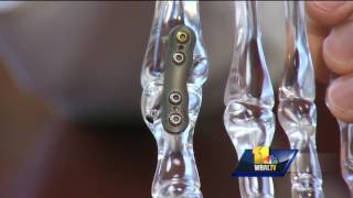 Video New procedure helps treat big toe arthritis [upl. by Anemolif]