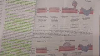 Colorectal Adenocarcinoma  SPECIAL PATHOLOGY [upl. by Adrianna]