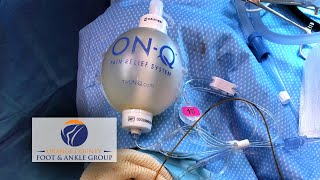 The ON Q Infusion Pain Pump for Regional Anesthesia Pain [upl. by Yoshiko]