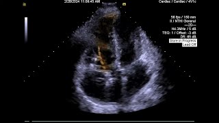 Case 4 Malfunctioning Tricuspid bioprosthesis [upl. by Corabella]