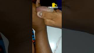 IV Cannulation Procedure technique mbbs shortvideo [upl. by Kester]