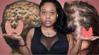 Thyroid CAUSES BALDING HAIR PRODUCTS WONT HELP BUT THIS VIDEO WILL ​⁠IamCynDoll [upl. by Acirt]