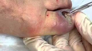 Dystrophic Ingrown Toenail [upl. by Crespo]