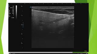 Echographie de la parotide le piège [upl. by Steffen]