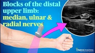 Ultrasound guided blocks of the median ulnar and radial nerves [upl. by Ayk]