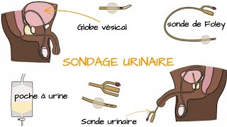 Comprendre le SONDAGE URINAIRE [upl. by Duahsar]