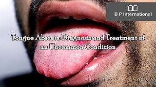 Tongue Abscess Diagnosis and Treatment of an Uncommon Condition [upl. by Fredric]