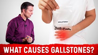 Does a High Fat Diet Causes Gallstones – Dr Berg [upl. by Llerej]