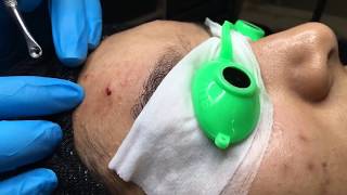 Professional Extractions Facial Lift amp Pump  Blackhead Extraction  Esthetician Training Tutorial [upl. by Entirb]