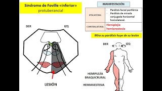 HEMIPLEJÍAS ALTERAS TRONCALES SINDROMES ALTERNOS [upl. by Sofko]