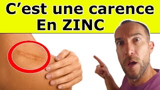 5 SIGNES qui montrent que vous manquez de ZINC [upl. by Elokcin214]