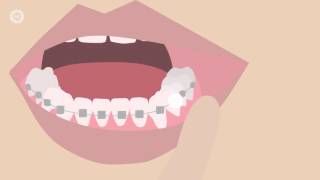 How To Deal With Braces Discomfort  Whats Normal Whats Not amp What To Do [upl. by Kennet]