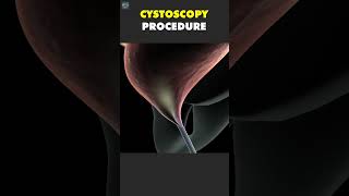 Cystoscopy Procedure Surgical3D 3DSurgery Anatomy3D [upl. by Ayanal]