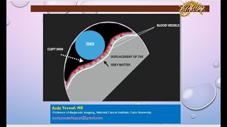 extra axial lesions [upl. by Ardy]