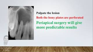 Large Periapical lesion Treatment Approach [upl. by Natasha]