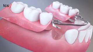 Flexible Partial Dentures Animation Video [upl. by Mcdade]