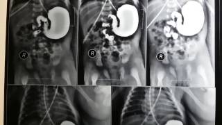 Barium meal showing malrotation of intestine Note intestinal content on one side [upl. by Allecram700]