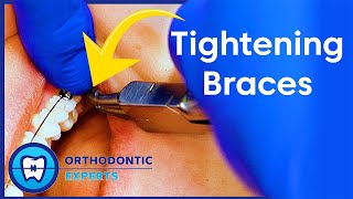 Tightening Braces  How amp Why Of Changing Wires [upl. by Adnerol]