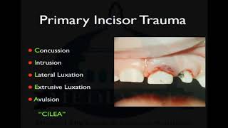 Primary Incisor Trauma  mediance academy [upl. by Eerej]