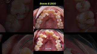 Cost  2500 for this case Braces crooked teeth braces orthodontist dentist [upl. by Yenroc]