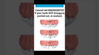 CONSULT AN ENDODONTIST IF YOUR TEETH GOT DISLODGEDdentist dentistry dental dentalcare [upl. by Ileray]