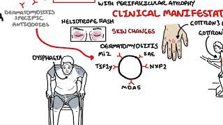 Dermatomyositis Overview [upl. by Darnall]