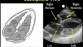 How to Echocardiography  Subxiphoid View [upl. by Heall140]