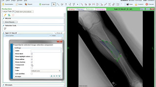 Reduction  Getting Started  Materialise OrthoView [upl. by Zohar]