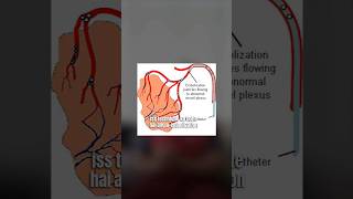 Identifying and understanding kidney angiomyolipomatumors urologist angioembolization [upl. by Amalita]