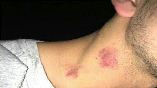 learn how to give someone a hickey easy [upl. by Bernelle]