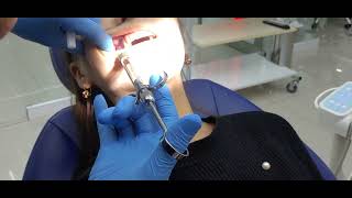 How to do dental anesthesia [upl. by Devi]