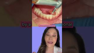 BTS Reshaping bumps on teeth Mamelons with Enameloplasty using Sanding Disc mamelons [upl. by Ruelle893]