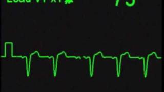 Left Bundle Branch Block LBBB [upl. by Brottman788]