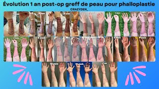 Évolution 1 an postop greffe de peau pour phalloplastie antébrachial Ftm français  CRAZYDEN [upl. by Goebel]