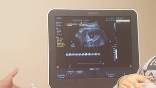 Ultrasound video showing 14weeks 4days  Nipt Genetic test Blasian [upl. by Yoshio]